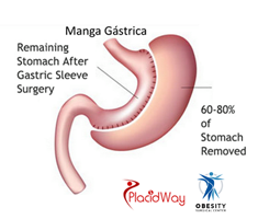 Slider image (4) Obesity Surgical Center | Dr. Jorge Reyes Mendiola